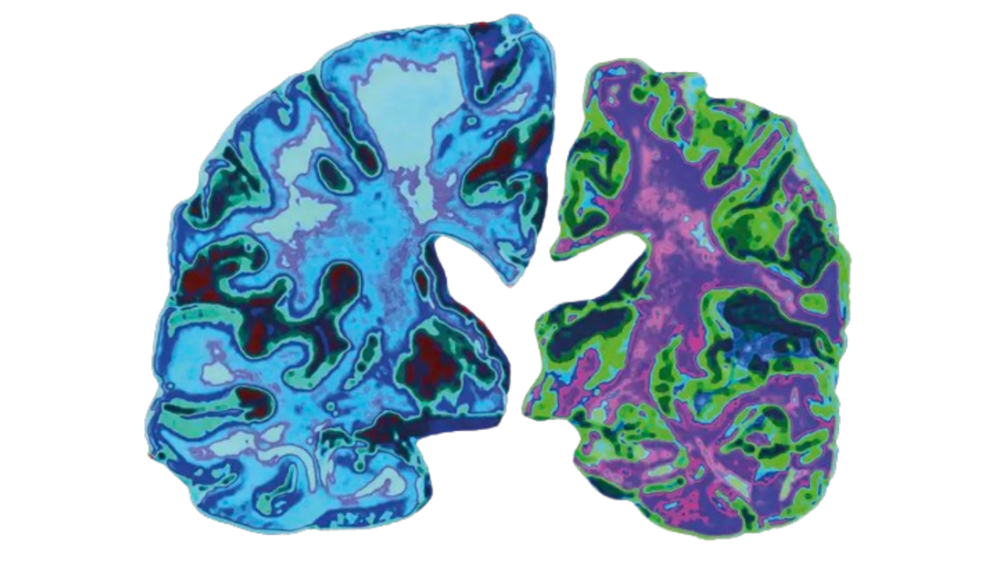 Alzheimer's Disease